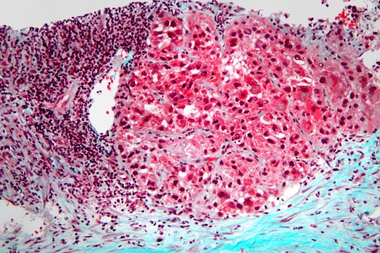 Imagem microscópica de carcinoma hepatocelular