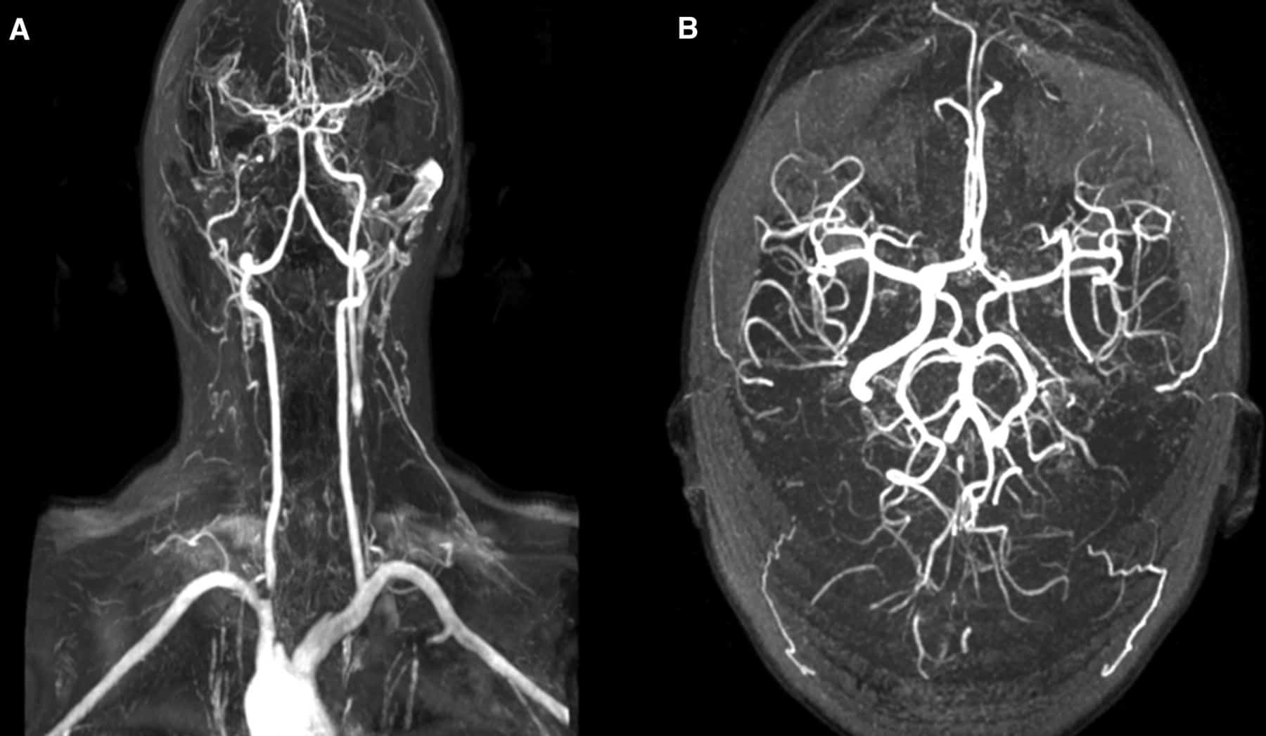 Ressonância magnética - Angiografia